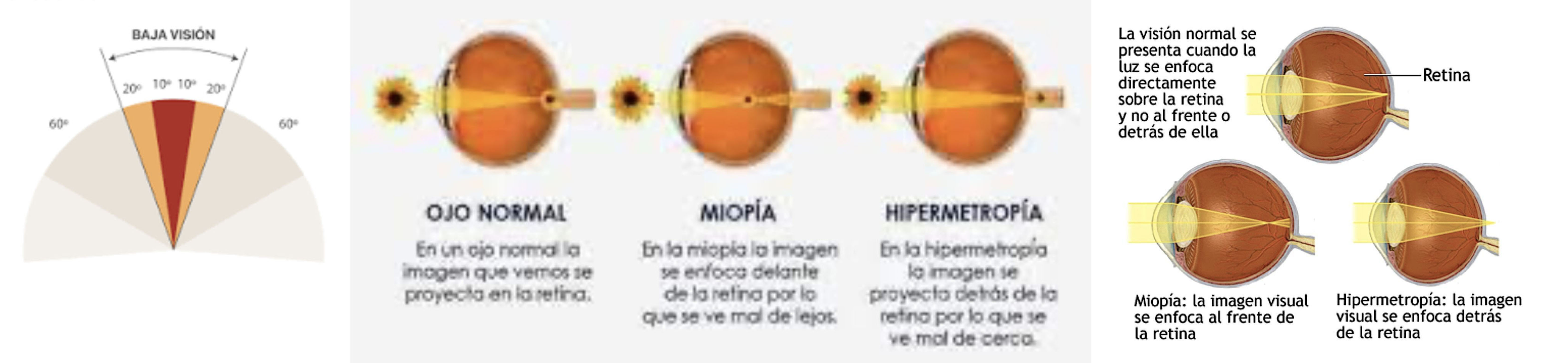 baja vision